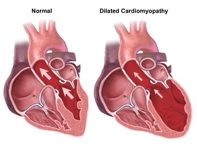 Left Ventricular Hypertrophy