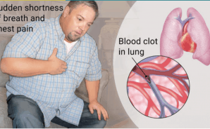 Pulmonary Embolism in Patients With Syncope