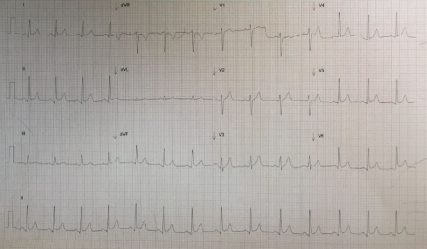 Pericarditis, Benign Early Depolarisation or STEMI