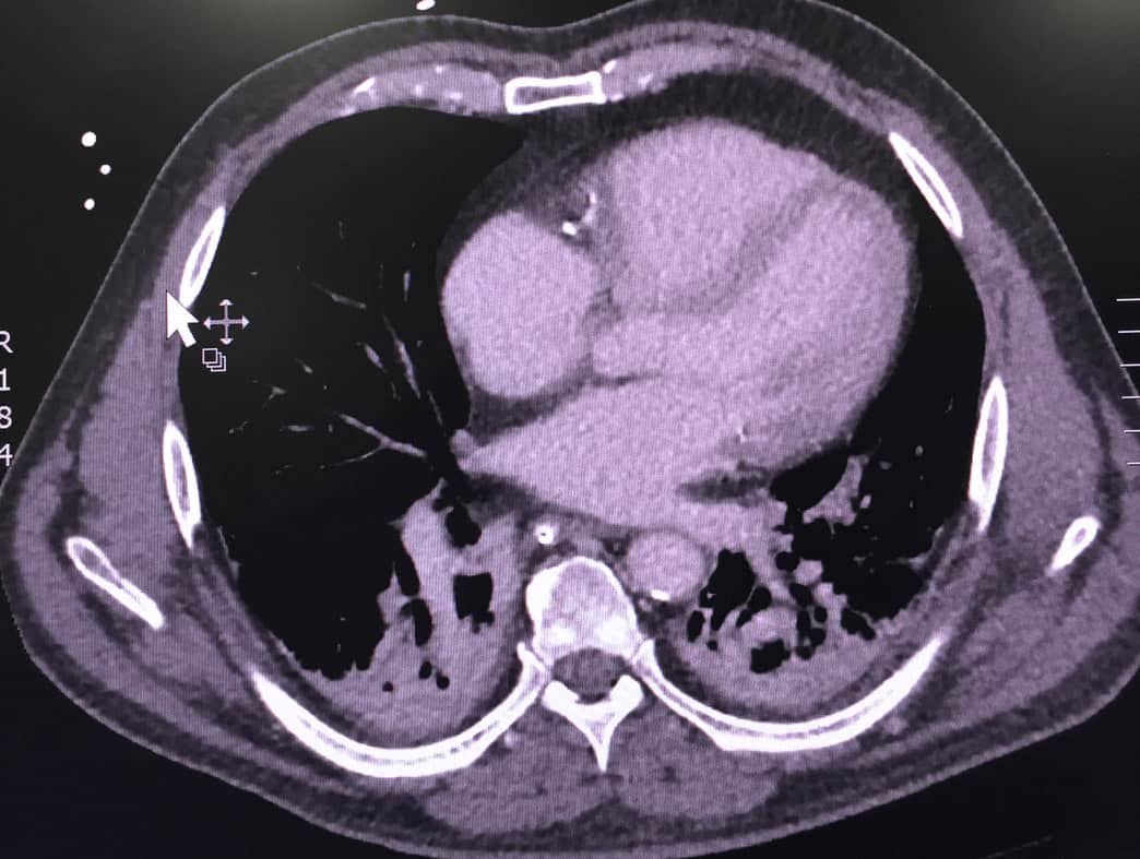 Severe Acidosis, Renal Failure and Metformin Toxicity