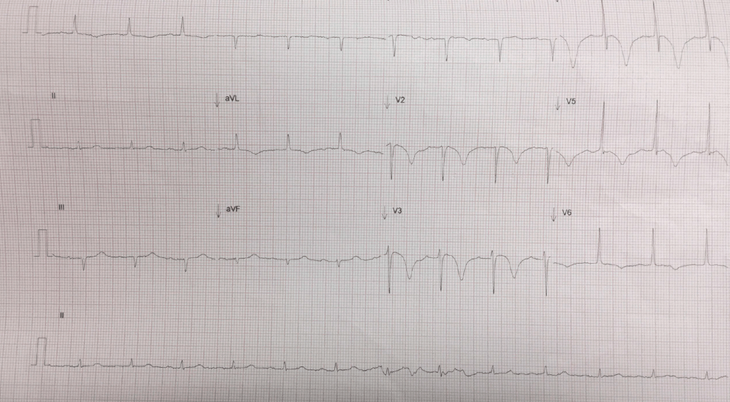 Wellen's Syndrome pattern