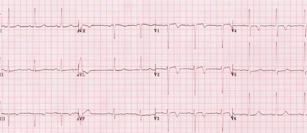 Wellen's Syndrome