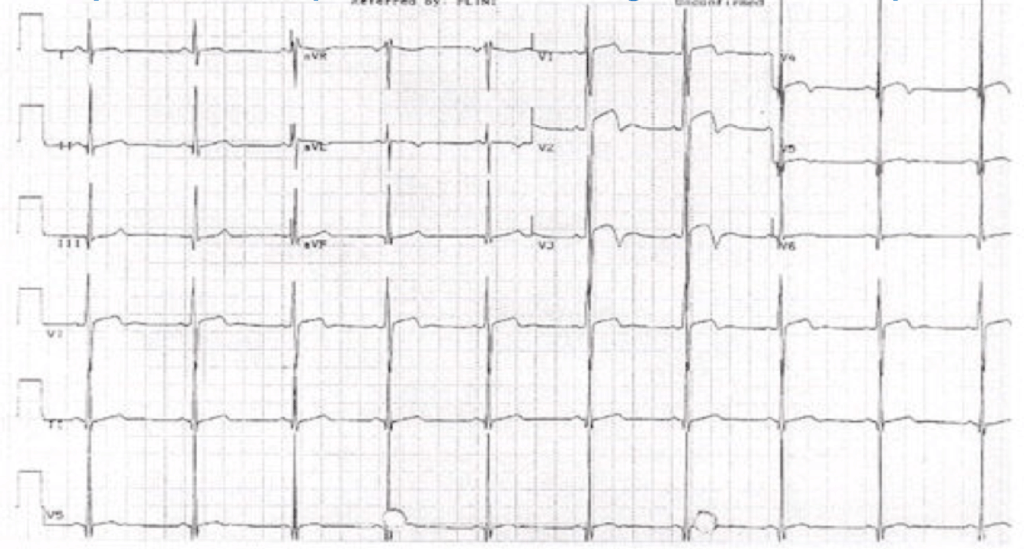 Pseudo-Wellens syndrome