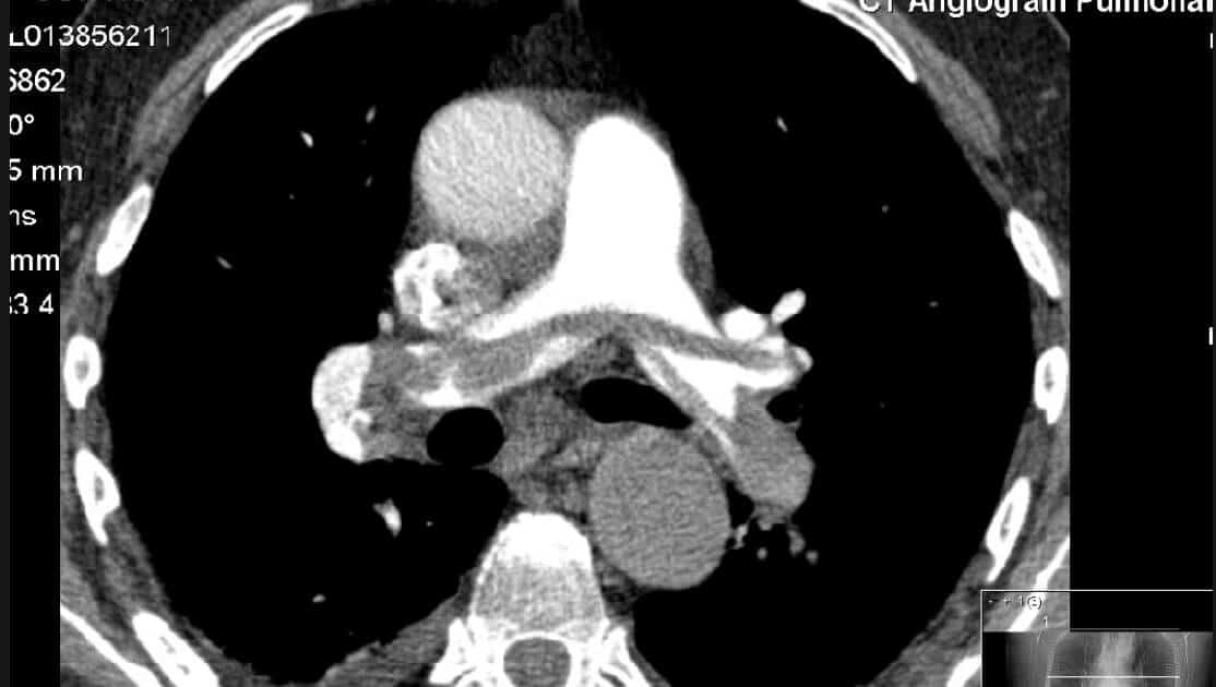 Which Patients with Pulmonary Embolism should get Thrombolysis?