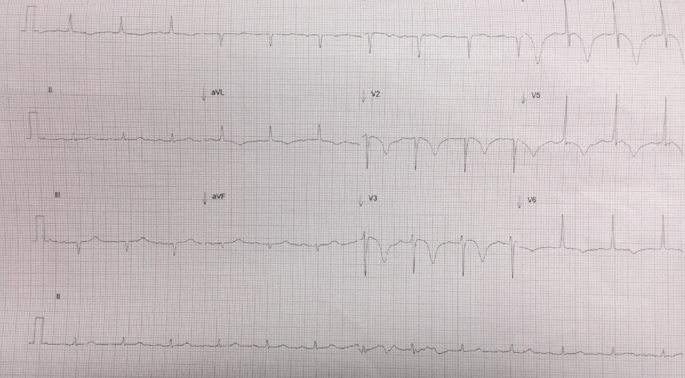 Wellen’s Syndrome