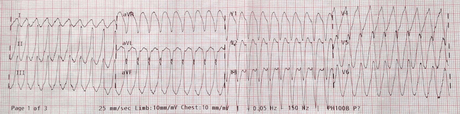 VT vs SVT with Aberrancy