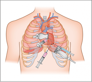 Different Pericardiocentesis Approaches and Risks