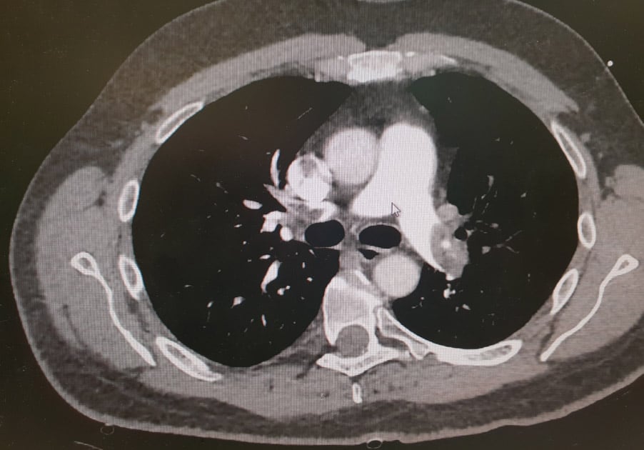 A 51 year old with collapse