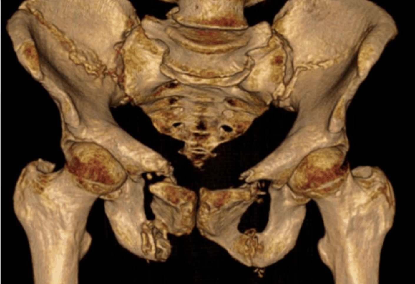 Unstable Pelvic Fractures