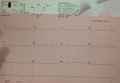 75 Year Old Male Who Feels Faint