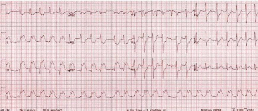 54 year old male with chest pain