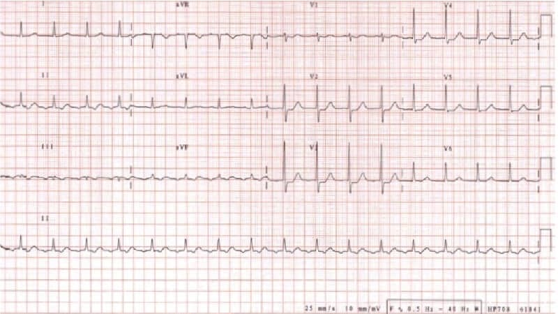 ECG Rhythm