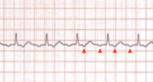 ECG P waves