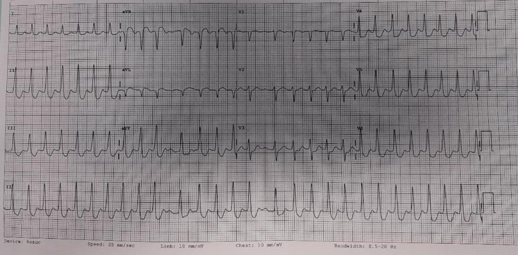 The Unstable Atrial Fibrillation Patient