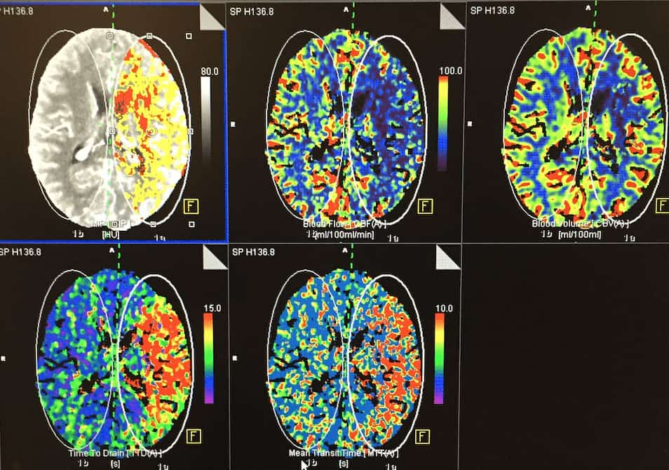 perfusion scan plus CTA