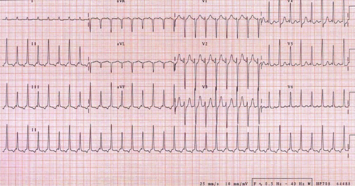 A 50 Year Old Man with Shortness of Breath and Sharp Chest Pain