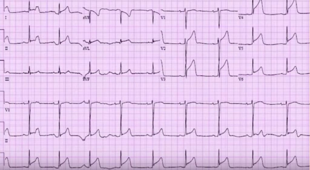 ECG of the week 22 Februrary 2017