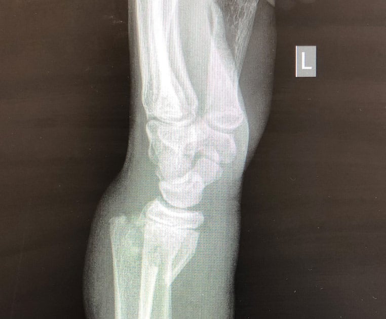 Smith’s Fracture Diagnosis and Management