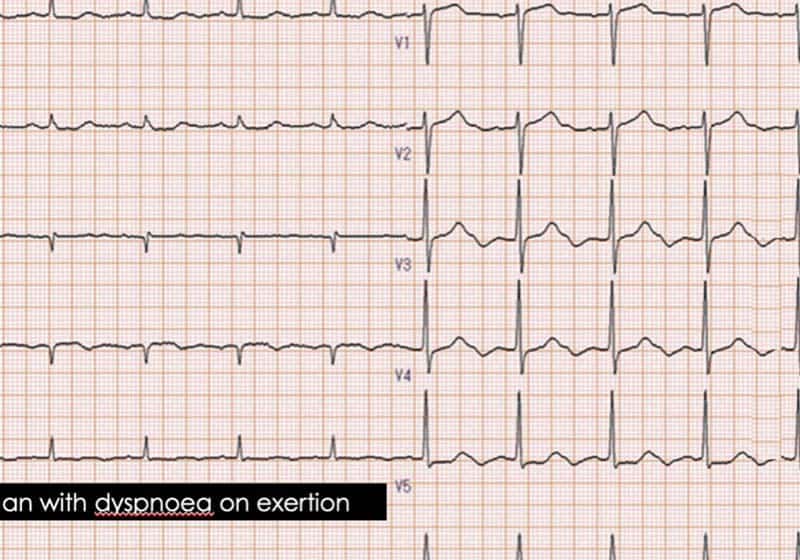 The U wave and the ECG: Don’t miss this