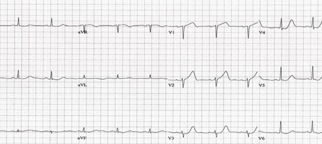 Upright T wave in V1