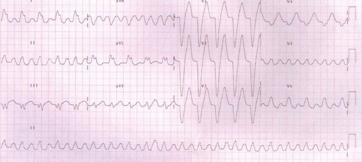 30 yo female with OD