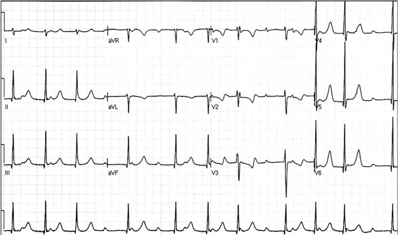 Module 2: The P wave and Blocks