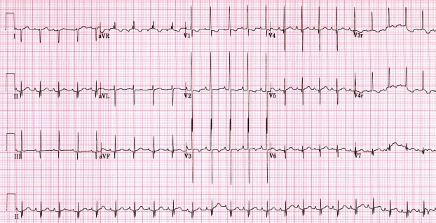 How to Read The Paediatric ECG