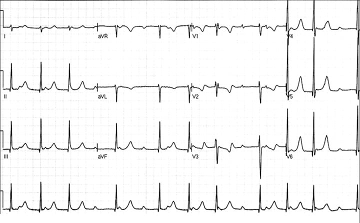 A Patient with Dizziness