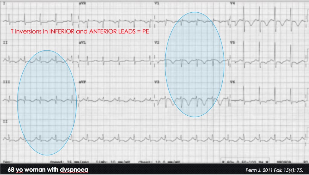 T wave inversion