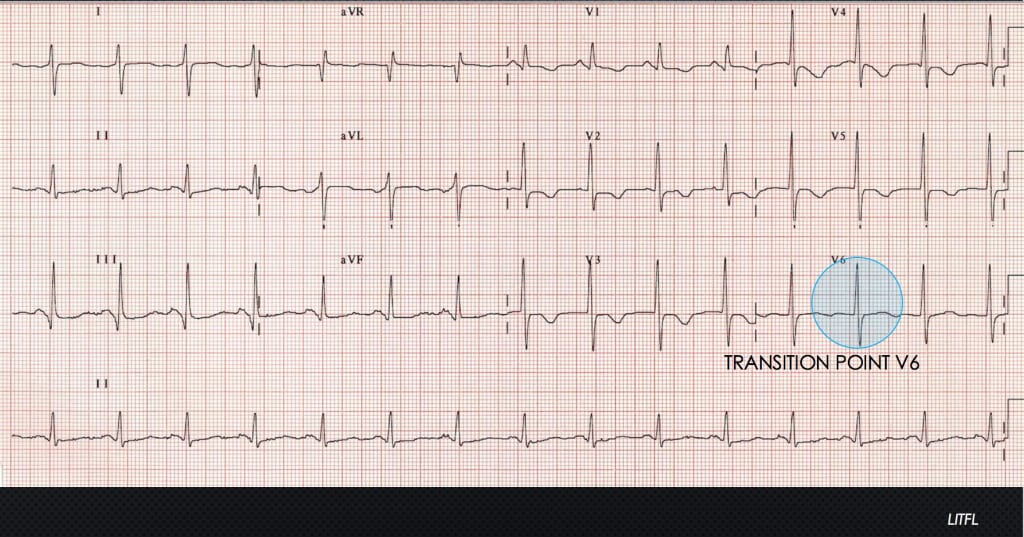 The ECG’s of Pulmonary Embolism