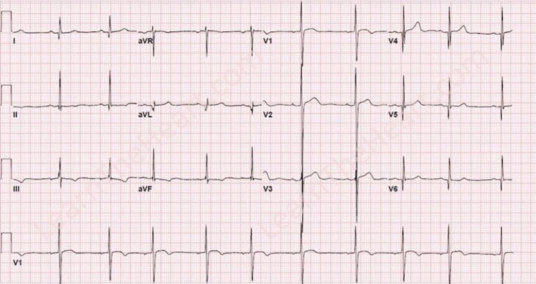 Module 3: The QRS