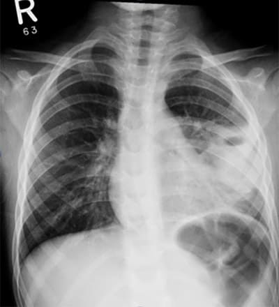 chest xray