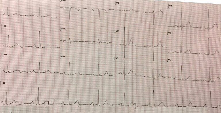 ECG of The Week – 24 April 2017