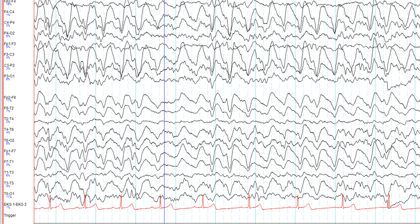 Phenytoin and Levetiracetam: EcLIPSE and ConSEPT trials