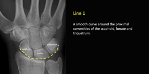 Gilula's carpal arcs