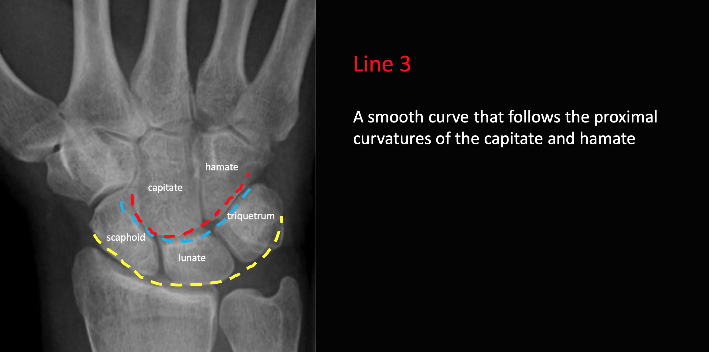 Gilula’s Carpal Arcs