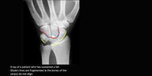 Gilula's carpal arcs