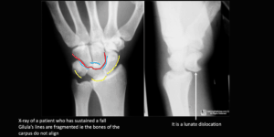 lunate dislocation