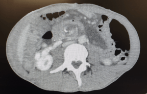 Bariatric Complication