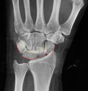 Gilula's carpal arcs