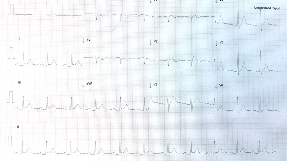 Brugada Syndrome