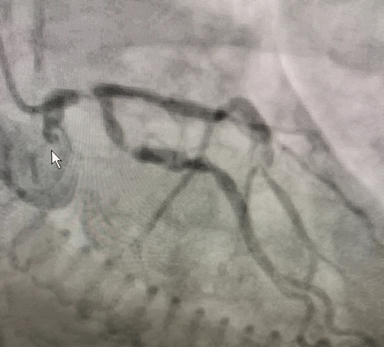 ST Elevation in aVR