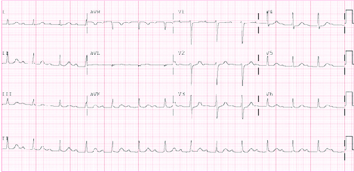 ECG predictors of Cardiac Arrhythmias in Elderly with Syncope