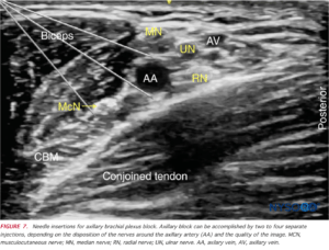 Demonstation of the anatomy of the brachial plexus axillary block approach