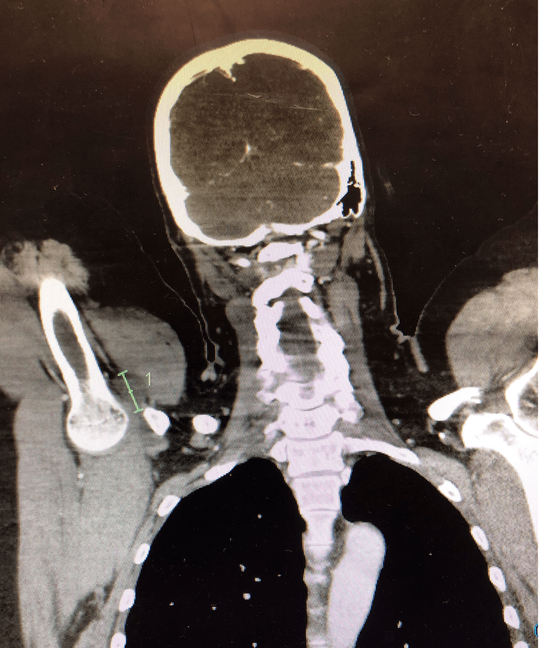 Brachial Plexus Block and its Complications