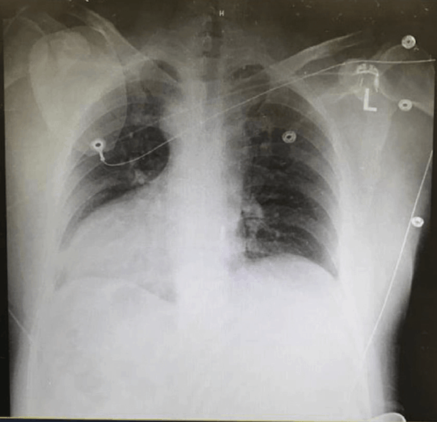 Dextrocardia: Can you pick it on ECG?