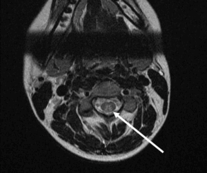 horacic hyperintense signal