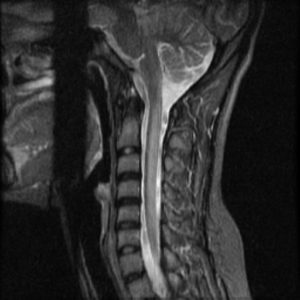 horacic hyperintense signal