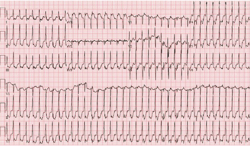 Is SVT an ischaemic arrhythmia?