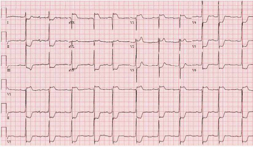 sinus rhythm